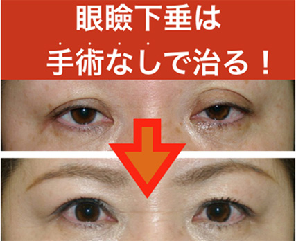 医学誌に掲載された 眼瞼下垂専用クリーム とは 医学誌に掲載された 眼瞼下垂専用クリーム とは